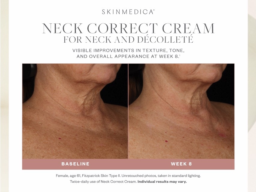 Before and After images of using SkinMedica Neck Correct Cream for 8 weeks on light skin