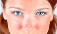 Learn About Rosacea Products and Symptoms During Rosacea Awareness Month