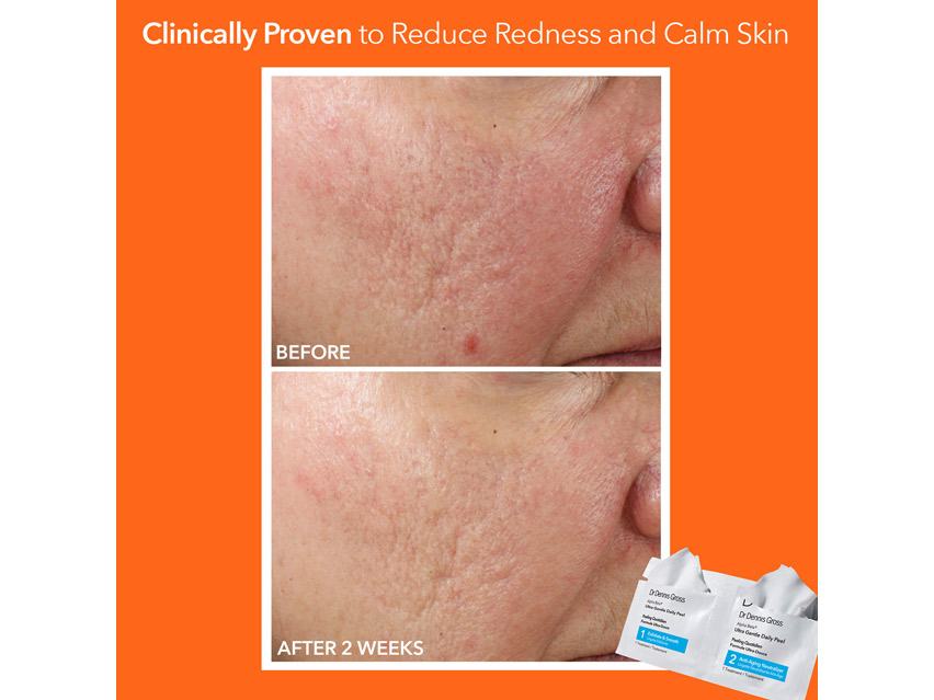 Dr. Dennis Gross Skincare Alpha Beta Ultra Gentle Daily Peel