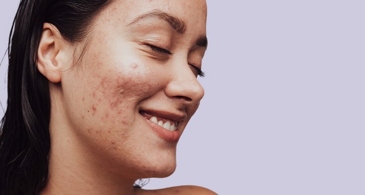 Everything you need to know about acne