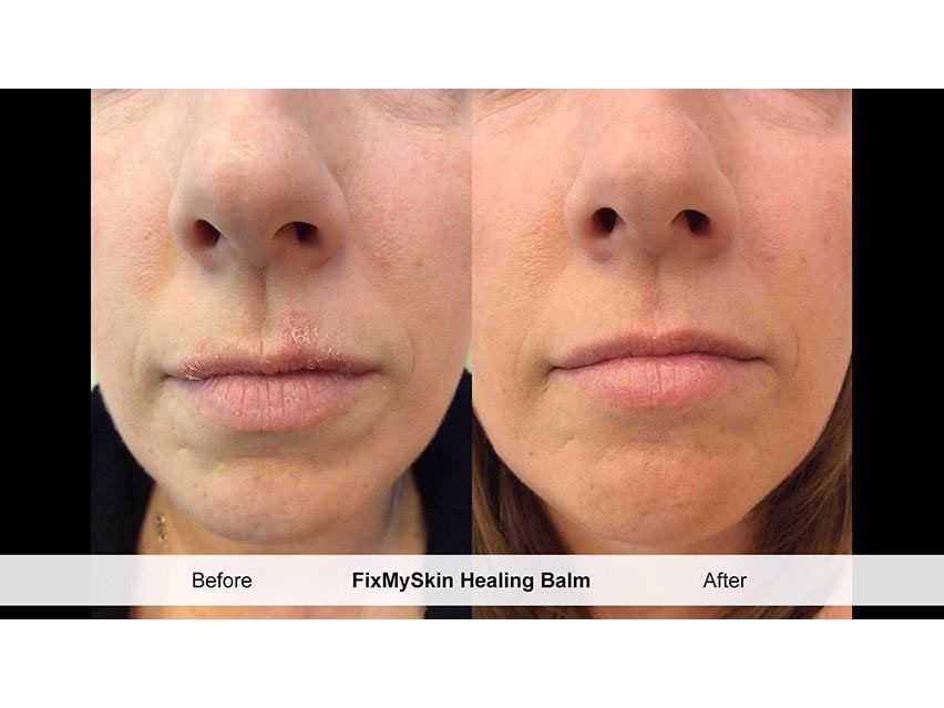 FixMySkin 1% Hydrocortisone Healing Lip Balm – Unflavored