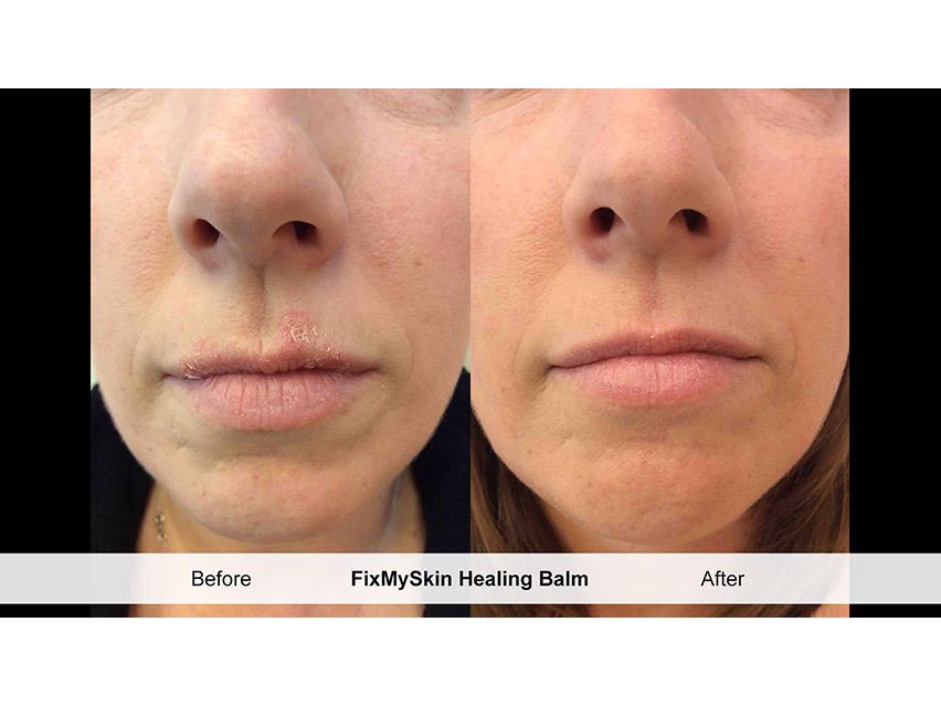FixMySkin 1% Hydrocortisone Healing Lip Balm – Unflavored – Pack of 12