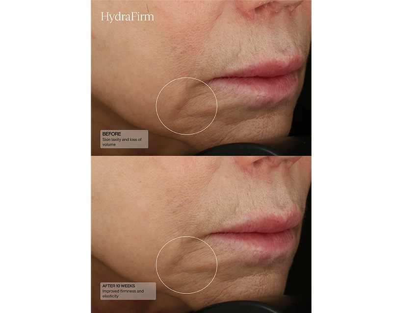 Senté HydraFirm Skin Firming Serum