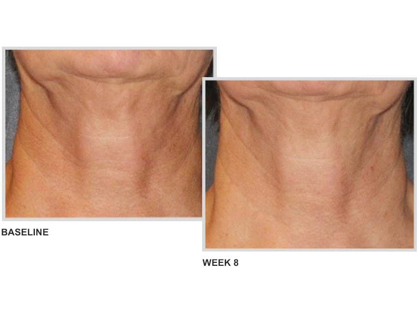 NeoStrata Skin Active Triple Firming Neck Cream: neck firming cream results.