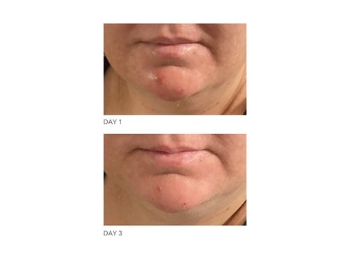 dr dennis gross blemish solution