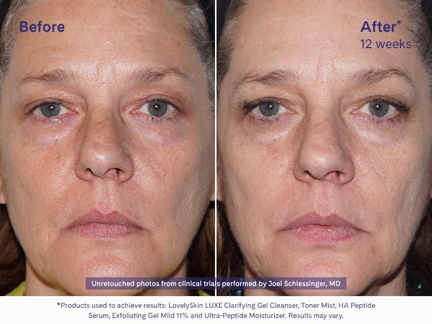 LovelySkin LUXE Exfoliating Gel Mild 11%