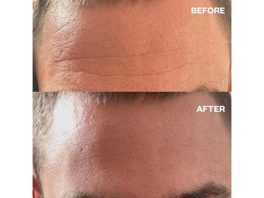 Wrinkles Schminkles Men's Pro Forehead Wrinkle Patches