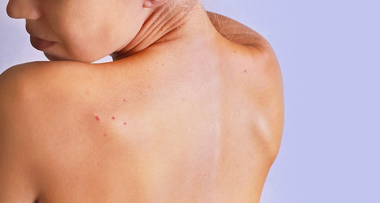 Four Weird Forms of Acne and How to Deal with Them