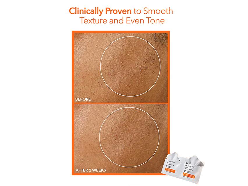 Dr. Dennis Gross Skincare Alpha Beta Peel Vault Gift Set - Limited Edition