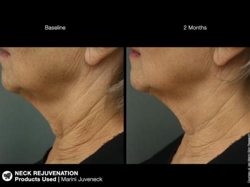 jan marini juveneck neck cream