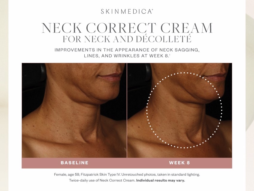 Before and After images of using SkinMedica Neck Correct Cream for 8 weeks on dark skin