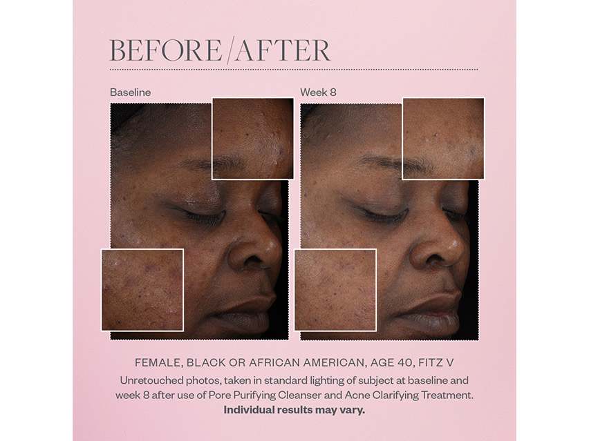 SkinMedica Acne Clarifying Treatment