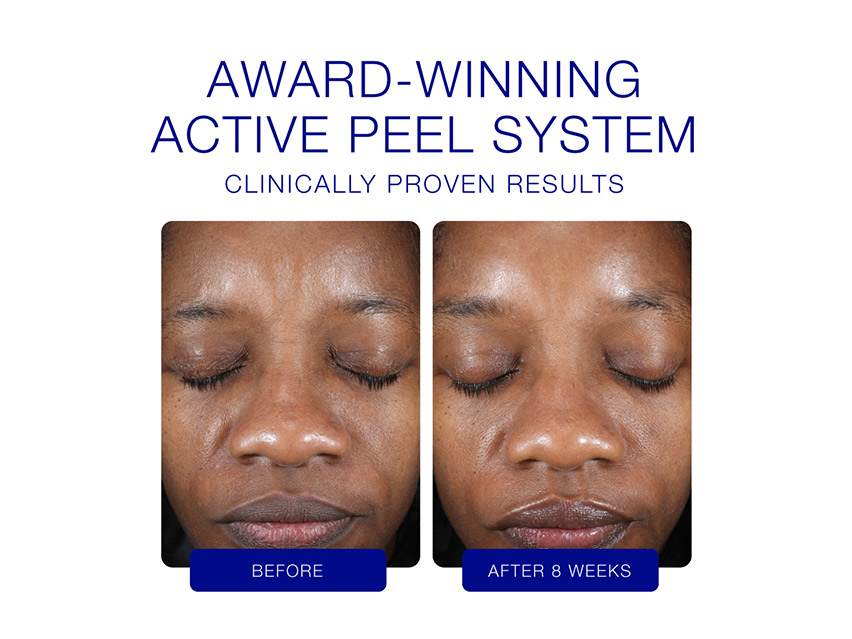 iS CLINICAL Active Peel System