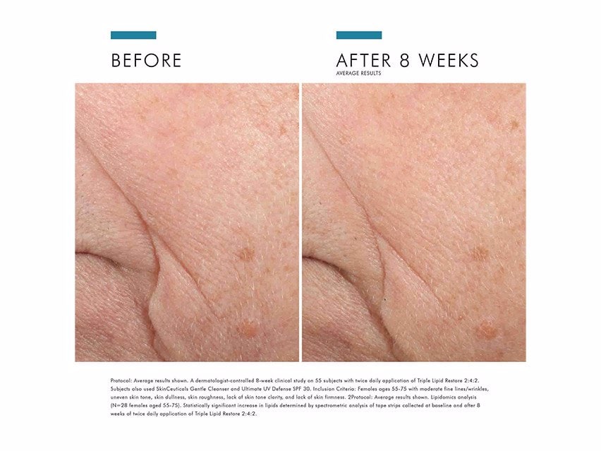 SkinCeuticals Triple Lipid Restore 2:4:2 Anti-Aging Cream before and after photos