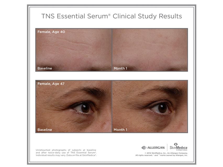 SkinMedica TNS Essential Serum before and after photos of woman. Shop LovelySkin for SkinMedica anti-aging serum products.