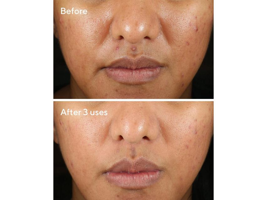 Murad Rapid Relief Acne Sulfur Mask