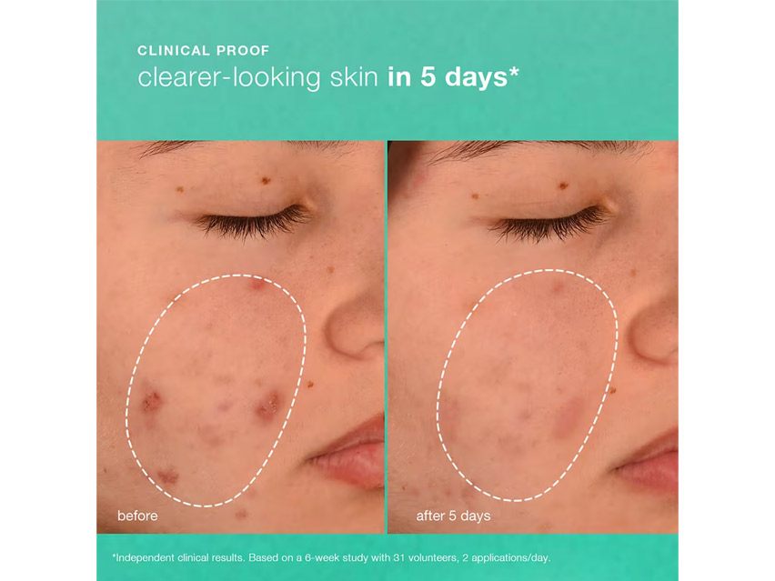 Dermalogica Acne Biotic Moisturizer