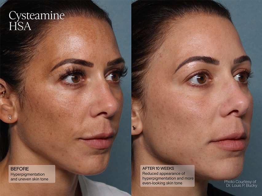 Senté Cysteamine HSA & Dermal Repair Cream Duo - $198 Value!