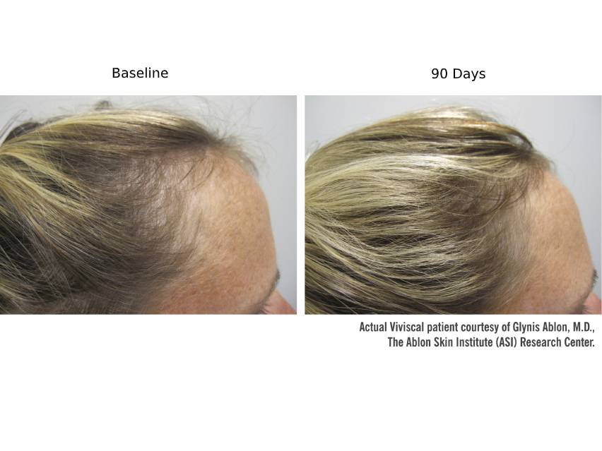 Viviscal Professional Hair Growth 9-Month Value Set