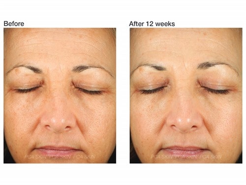 use pca skin with retinol serum