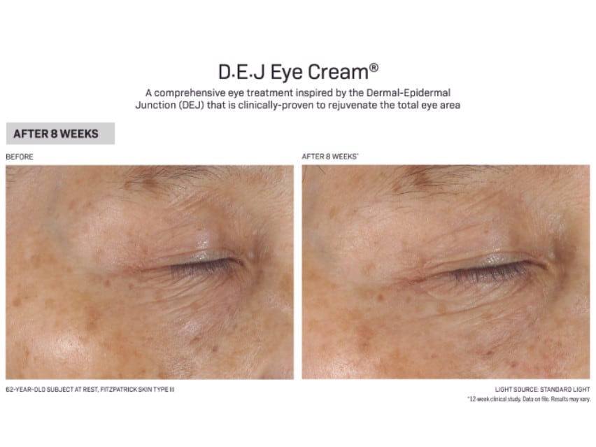 Revision Skincare D·E·J Eye Cream Before and After Results on light skin