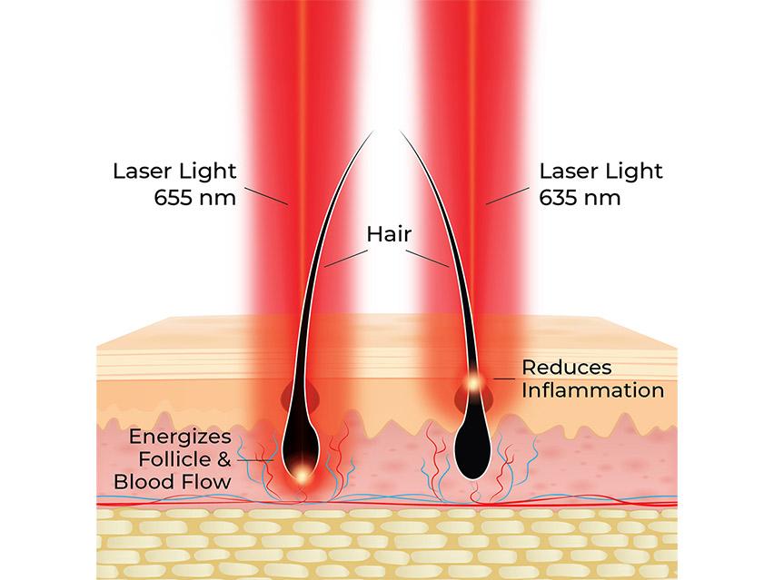 HairMax Actonis 18 Dual Action LaserComb