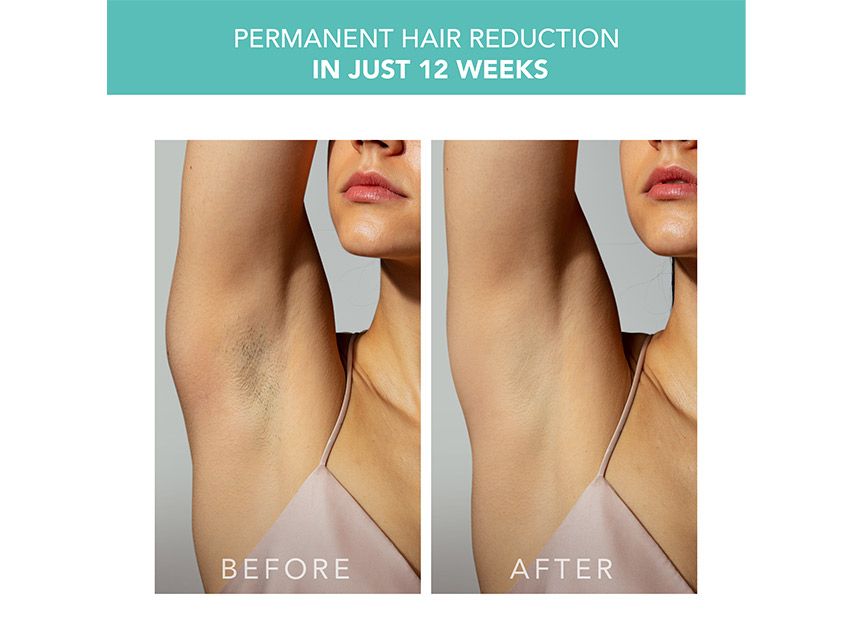 FOREO Peach 2 IPL Hair Removal Device &amp; PEACH Cooling Prep Gel Set - Limited Edition