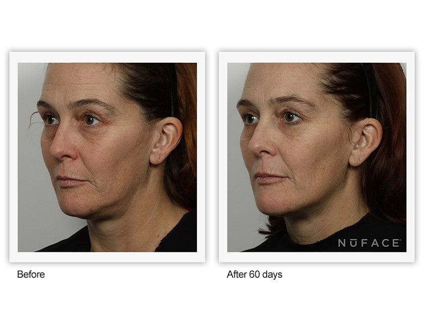 Woman with reduced crow's feet and eye circles from use of NuFace Trinity Facial Trainer with Trinity Wrinkle Reducer Attachment