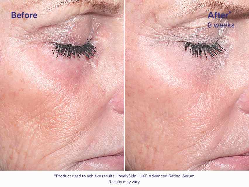 LovelySkin LUXE Advanced Retinol Serum