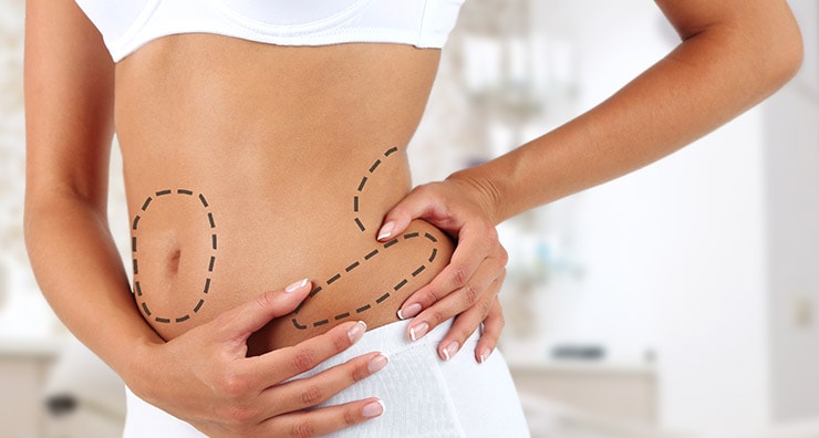 CoolSculpting vs. Liposuction