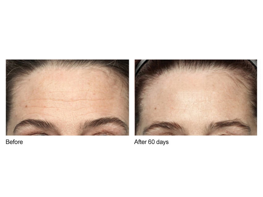 Before & after photos of wrinkle reduction from use of the NuFace Trinity Facial Trainer with Trinity Wrinkle Reducer Attachment