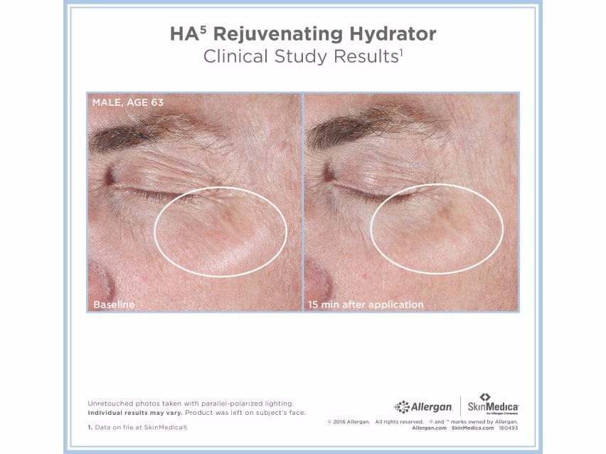 SkinMedica HA5 Rejuvenating Hydrator before and after results for men