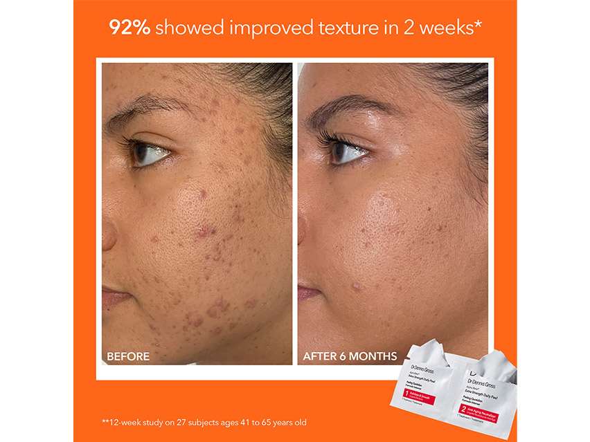 Dr. Dennis Gross Skincare Radiant, Smooth &amp; Firm Extra Strength Daily Peel Kit - Limited Edition