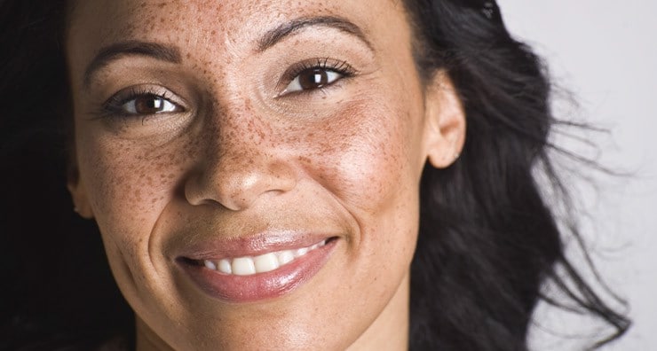 How to Improve Dark Spots in 5 Easy Steps