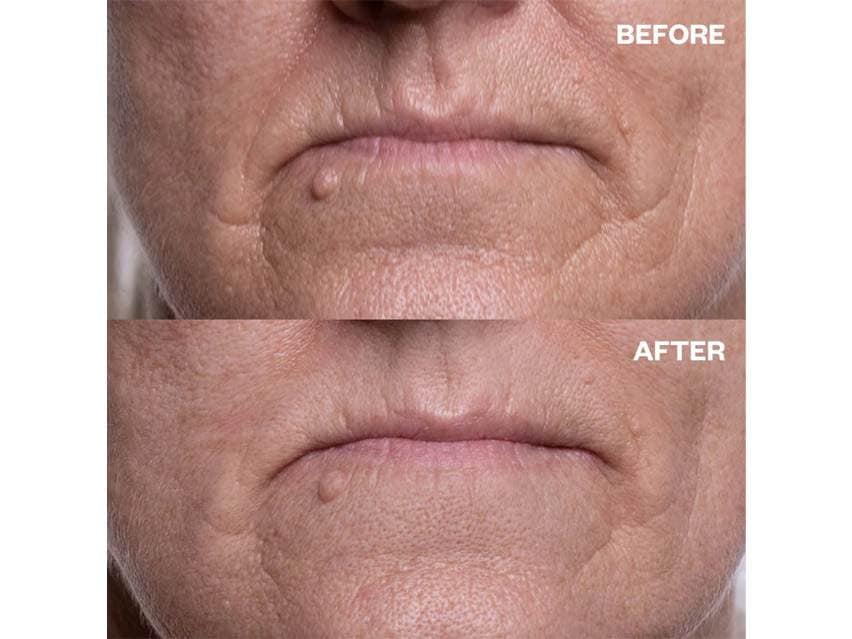 Wrinkles Schminkles Mouth &amp; Lip Wrinkle Smoothing Patches