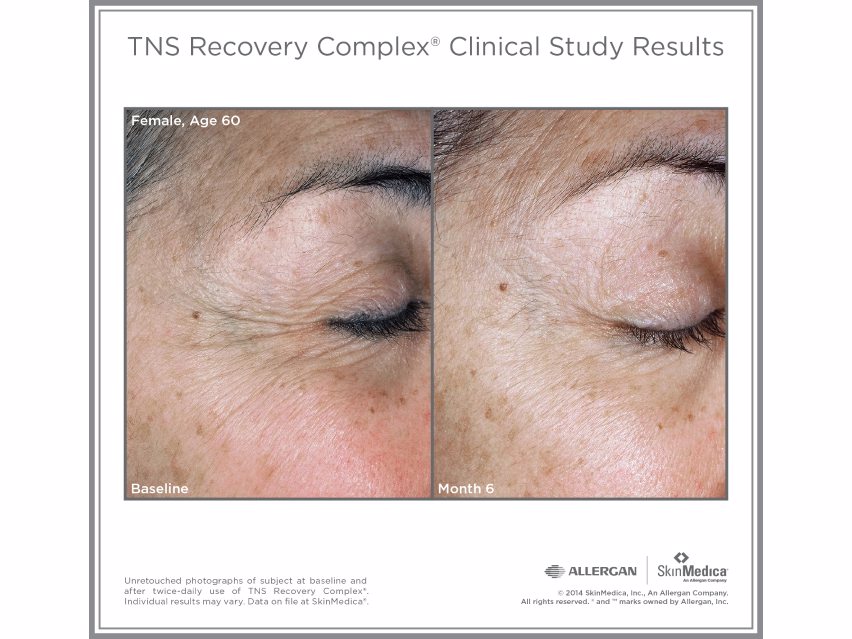 SkinMedica TNS Recovery Complex before and after