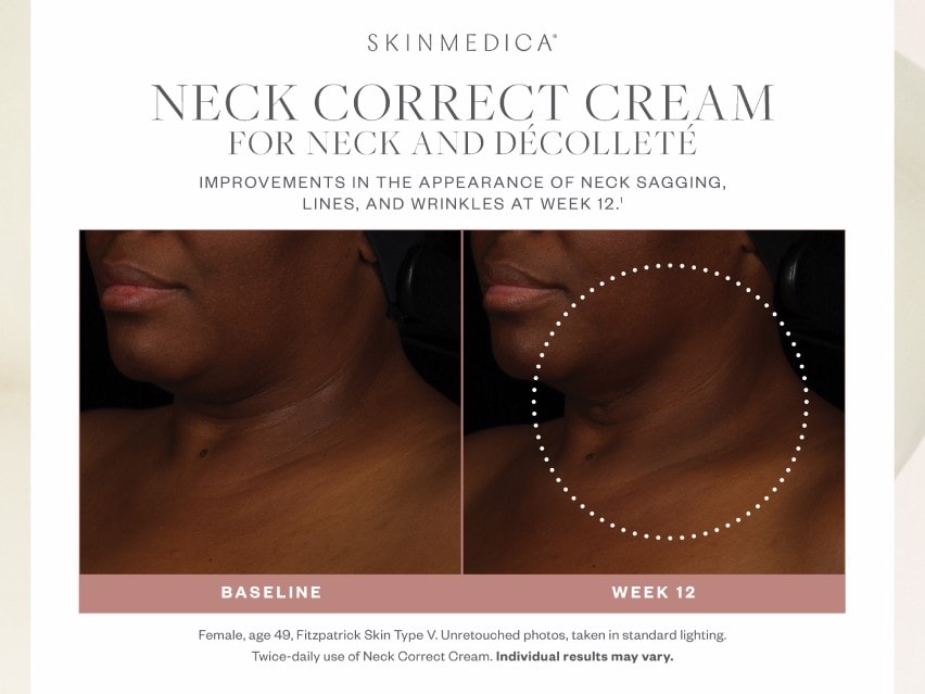 Before and After images of using SkinMedica Neck Correct Cream for 12 weeks