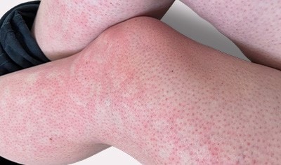 Laptop rash and erythema ab igne: What you need to know