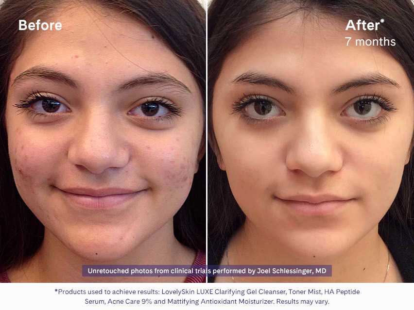 LovelySkin LUXE Clarifying Gel Cleanser