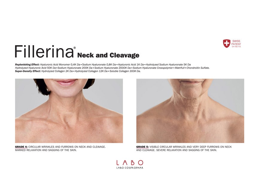 Fillerina Neck and Cleavage Treatment Grade 4