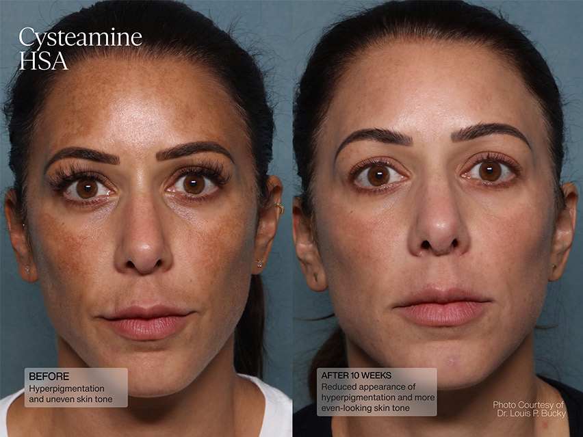 Senté Cysteamine HSA & Dermal Repair Cream Duo - $198 Value!