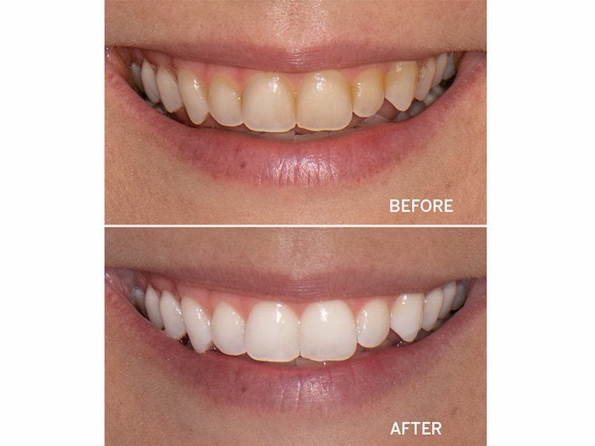 Supersmile Professional Whitening System