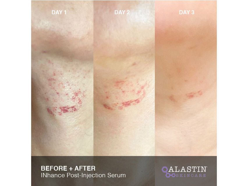 ALASTIN Skincare INhance Post-Injection Serum with TriHex Technology