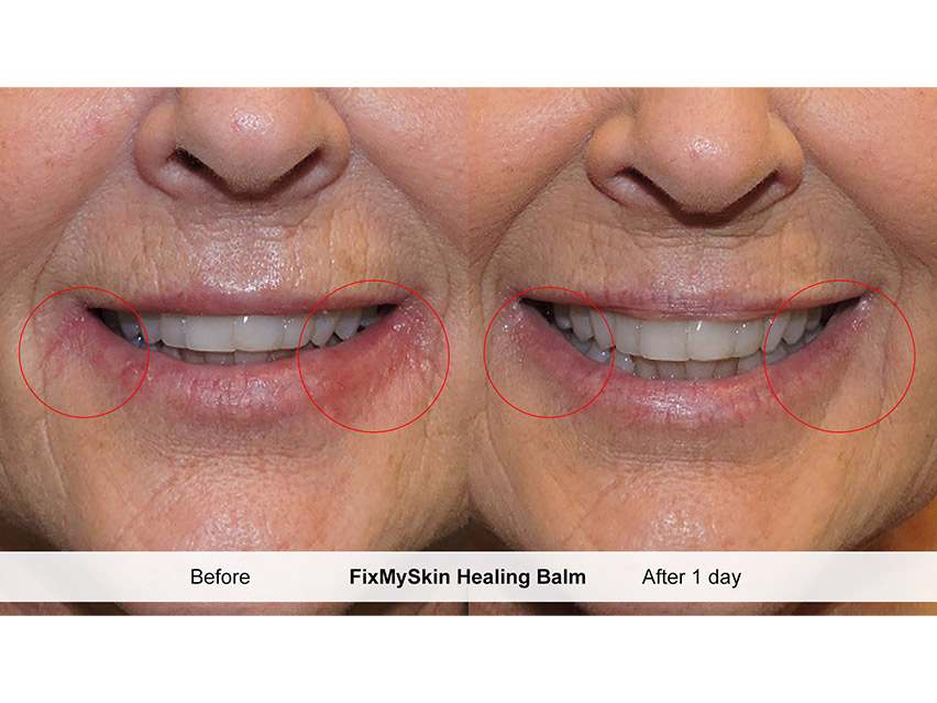 FixMySkin 1% Hydrocortisone Healing Lip Balm – Vanilla – Pack of 6