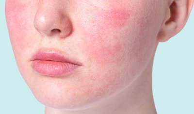 Your Best Skin Care Routine for Rosacea
