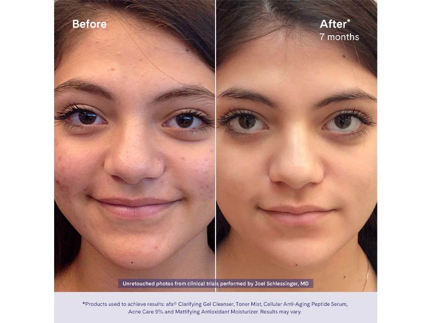 afa Acne Care