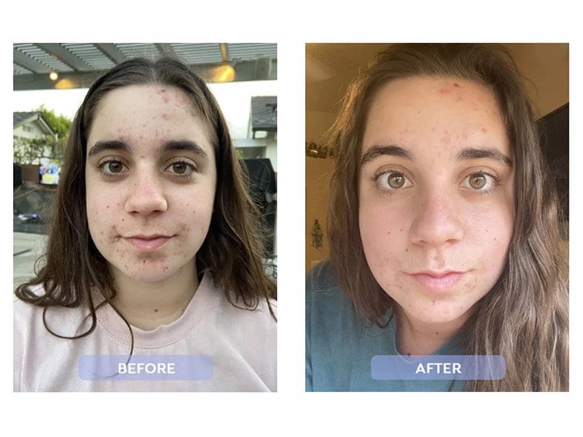 benzoyl peroxide before and after