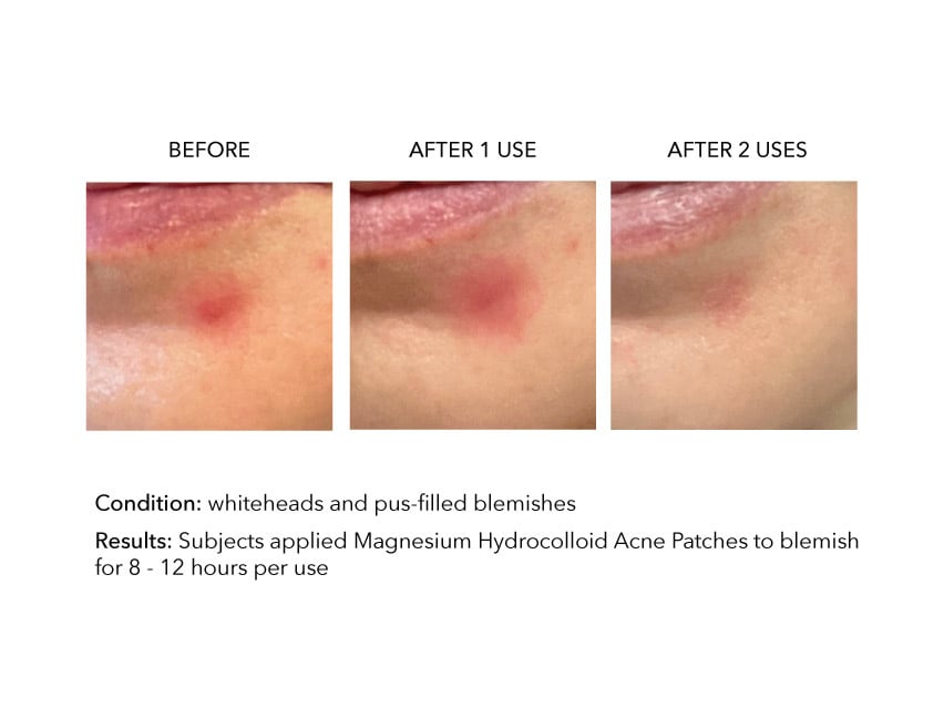 Soon Magnesium Hydrocolloid Acne Patches