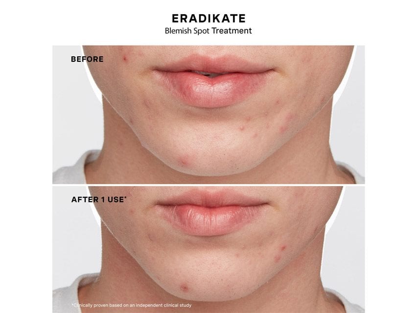 Kate Somerville The Clear Skin Set - Limited Edition