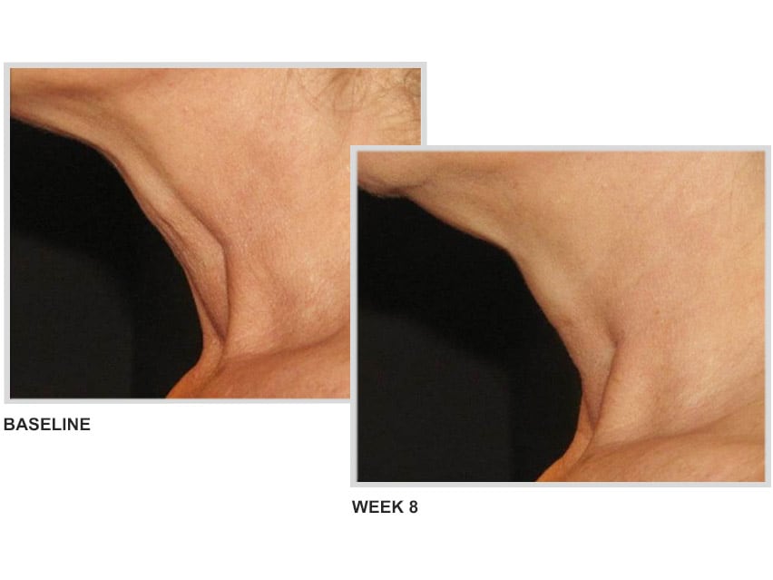 NeoStrata Skin Active Triple Firming Neck Cream: neck firming cream results.